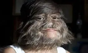 پرموترین دختر جهان، دختر که به «صورت میمونی» معروف است