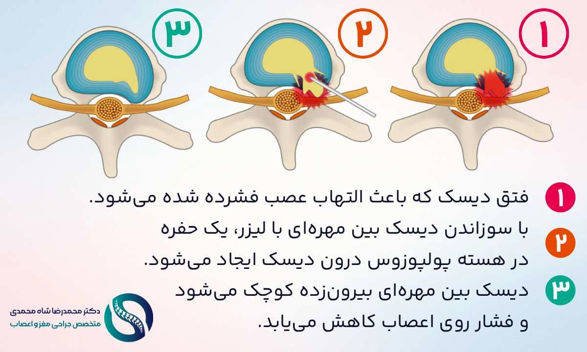 جراحی لیزری دیسک کمر (PLDD) چیست؟