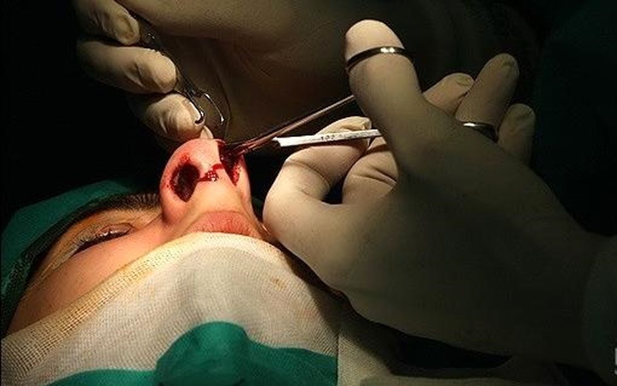 رکورد عجیب ایرانی‌ها در جراحی بینی/ ۱۸ ساله‌ها، رکورد‌دار جراحی بینی در ایران