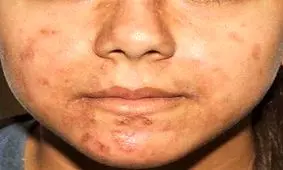 ۱۰ راهکار ساده و کاربردی برای درمان جوش بدن