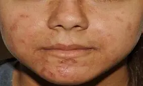۱۰ راهکار ساده و کاربردی برای درمان جوش بدن