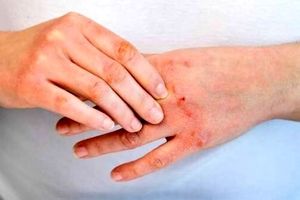 علامت بیماری کبد روی دست ها