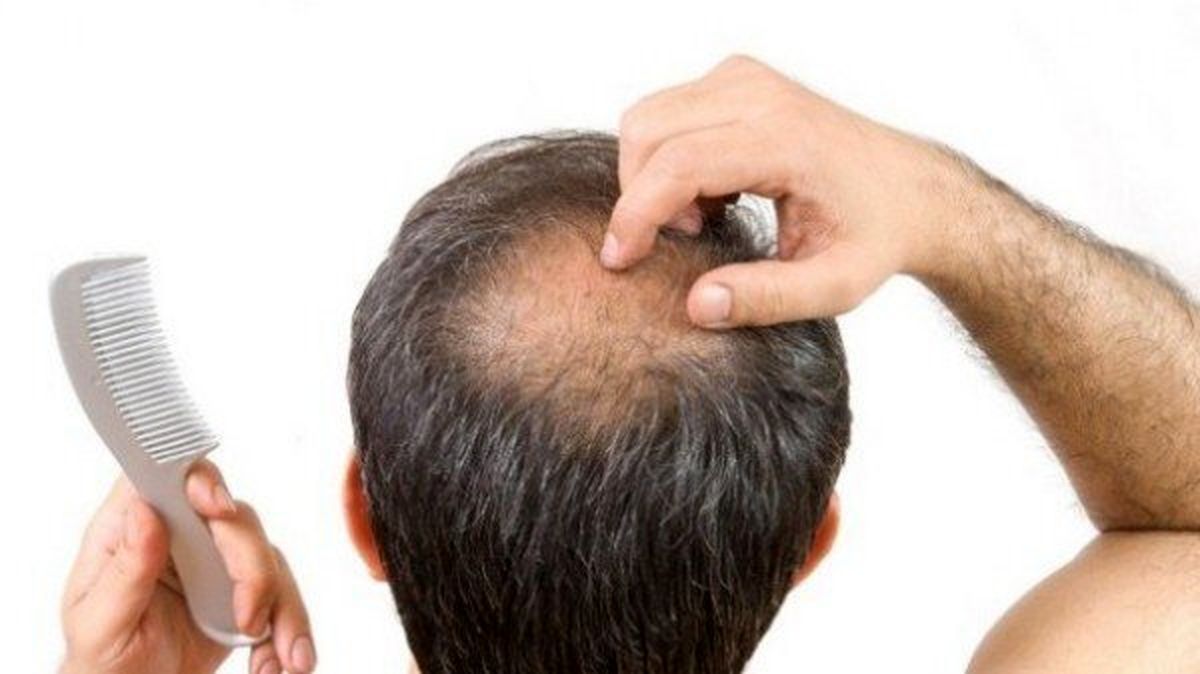 در تله کندن مو گرفتار نشوید