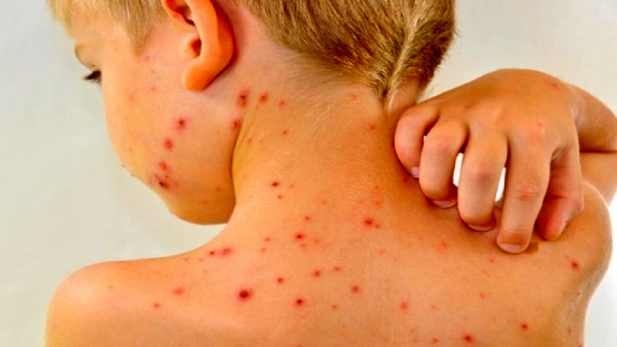 سرخک به ایران برگشت/ واکسنگریزان تحویل بگیرید