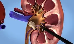 سنگ بزرگ زیر از کلیه یک بیمار خارج شد/ عکس
