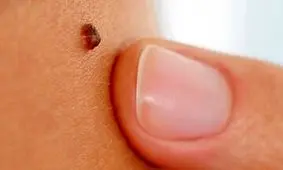اگر این خال های خطرناک را دارید به پزشک مراجعه کنید