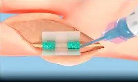 چسبی برای بستن زخم‌های عمیق که با نور فعال می‌شود

