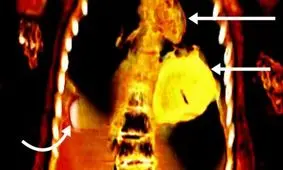 «پسر طلایی» مصر؛ جسد مومیایی شده‌ای با قلب و زبانی از طلا