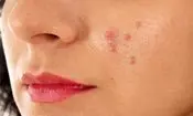 این مواد غذایی باعث بروز آکنه و جوش می‌شوند
