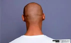 ۴ کشور جهان با بیشترین تعداد مردان کچل