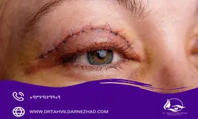 بایدها و نبایدهای فعالیت های فیزیکی بعد از عمل جراحی پلک