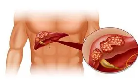 علایم و درمان «کیست هیداتید» و روند بروز آن در کشور