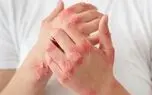 هشدار متخصصان؛ پسوریازیس قلب و مفاصل را هم درگیر می‌کند