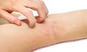 تشدید اگزما در سرما/ پوست چرب بهتر است یا خشک؟