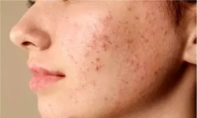 این خوراکی‌ها باعث جوش صورت می‌شود/ برای کنترل آکنه چه بخوریم؟