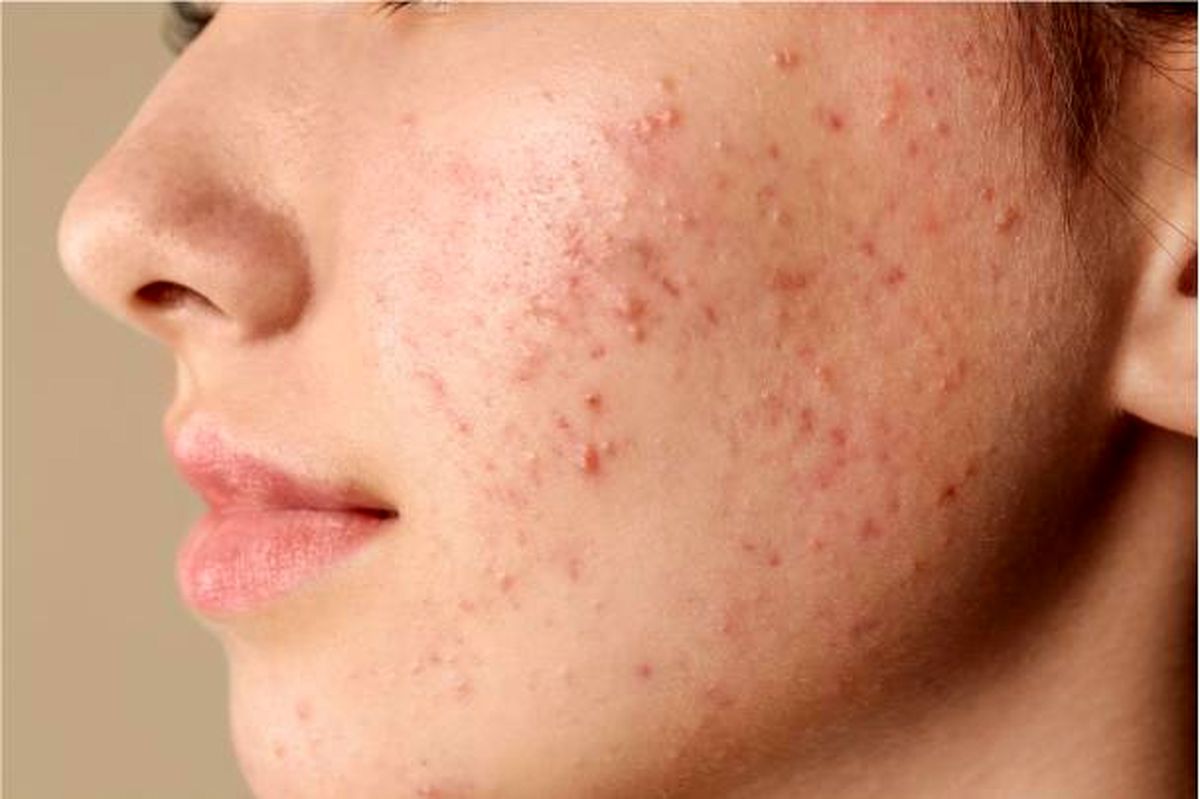 این خوراکیها باعث جوش صورت میشود/ برای کنترل آکنه چه بخوریم؟