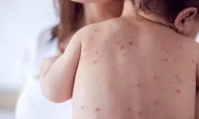 هشدار شیوع آبله مرغان در فصل بهار