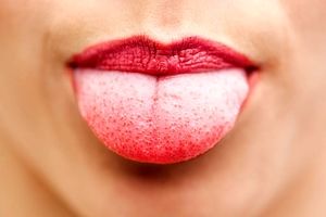 پیوند زبان جدید از ران بیمار مبتلا به سرطان زبان