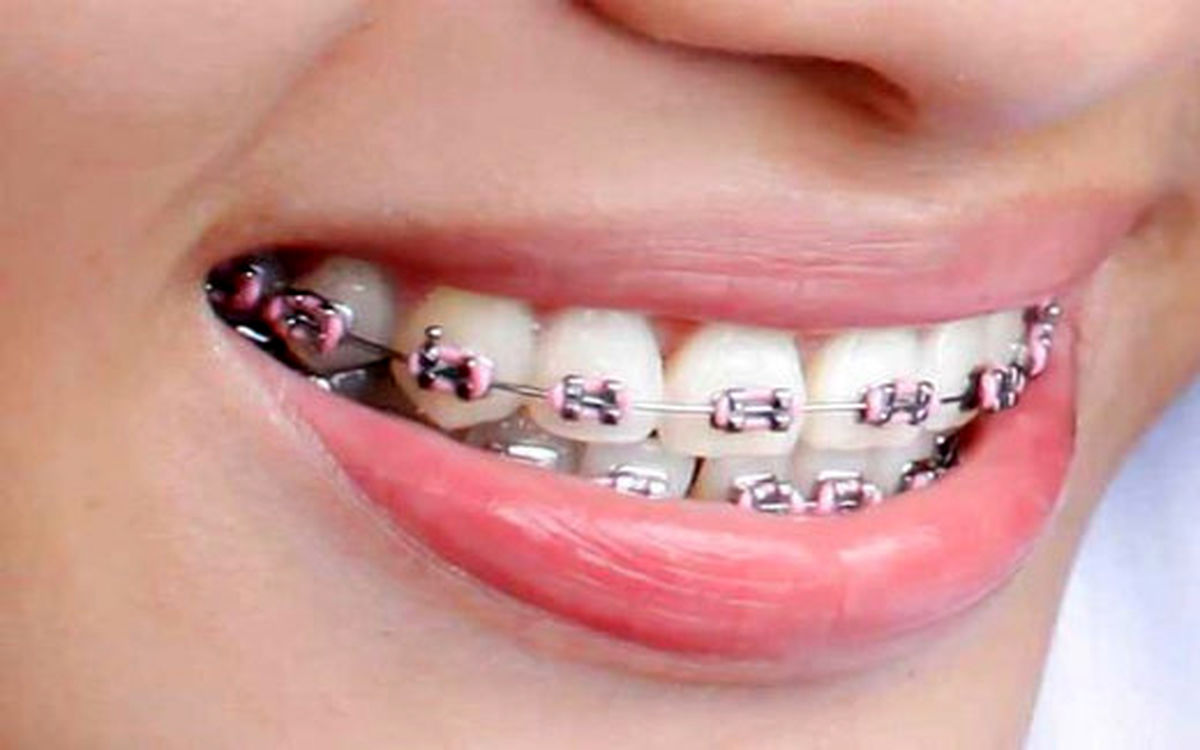 چرا بیماران ارتودنسی باید بیشتر به بهداشت دهان توجه کنند؟