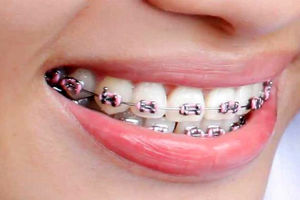 چرا بیماران ارتودنسی باید بیشتر به بهداشت دهان توجه کنند؟