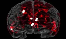 نانوربات‌ها با موفقیت خونریزی مغز را متوقف کردند

