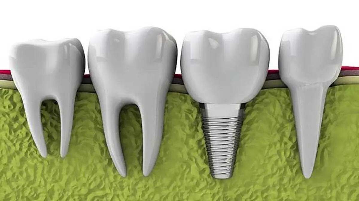 ایمپلنت spi چیست ( قیمت ایمپلنت spi ) 

