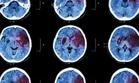 چگونه از سکته مغزی جلوگیری کنیم؟