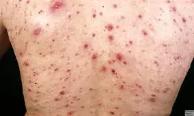 بیماری پی ال سی چیست؟