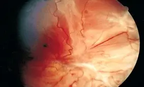 سرمایه‌گذاری "وزارت دفاع آمریکا" برای پژوهش درباره یک بیماری نادر چشمی