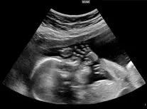 بارداری یک دختر ۱۳ساله در مشهد جنجال به‌پا کرد/ ویدئو