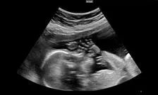 بارداری یک دختر ۱۳ساله در مشهد جنجال به‌پا کرد/ ویدئو