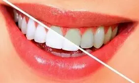 خوراکی هایی که مثل مسواک دندان هایتان را تمیز می‌کنند