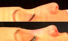 زنان ایرانی بینی کدام خانم بازیگر را دوست دارند؟ / یک دکتر از تغییر نگرش دختران ایرانی به سمت نچرال بودن گفت