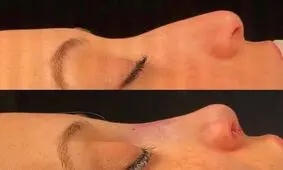 زنان ایرانی بینی کدام خانم بازیگر را دوست دارند؟ / یک دکتر از تغییر نگرش دختران ایرانی به سمت نچرال بودن گفت