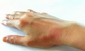 علت ابتلا به لوپوس چیست؟