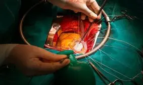 پزشک شیرازی دریچه قلب از بافت بدن بیمار ساخت