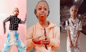 زنی مبتلا به بیماری نادری که بدون چانه به دنیا آمده است/ ویدئو

