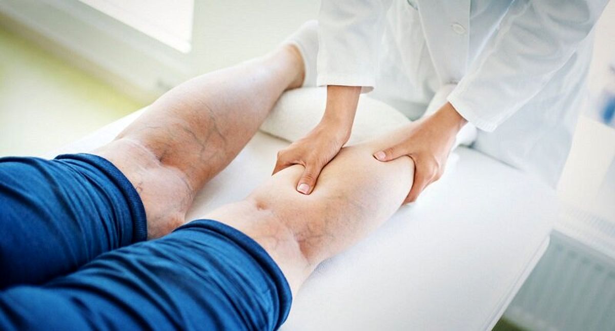 راهکارهای ساده خانگی برای جلوگیری از واریس پا