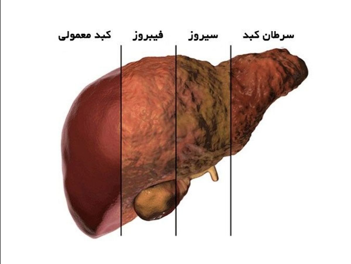 هر شش ماه برای بررسی سلامت کبد آزمایش بدهید/ لوله قلیان به انواع قارچ‌ها آلوده است/ چه مواد غذایی منجر به کبد چرب می‌شود؟