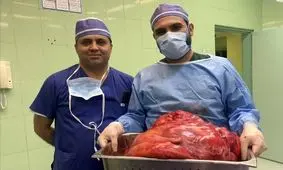خارج کردن توده ۲۳ کیلویی از شکم خانم تبریزی
