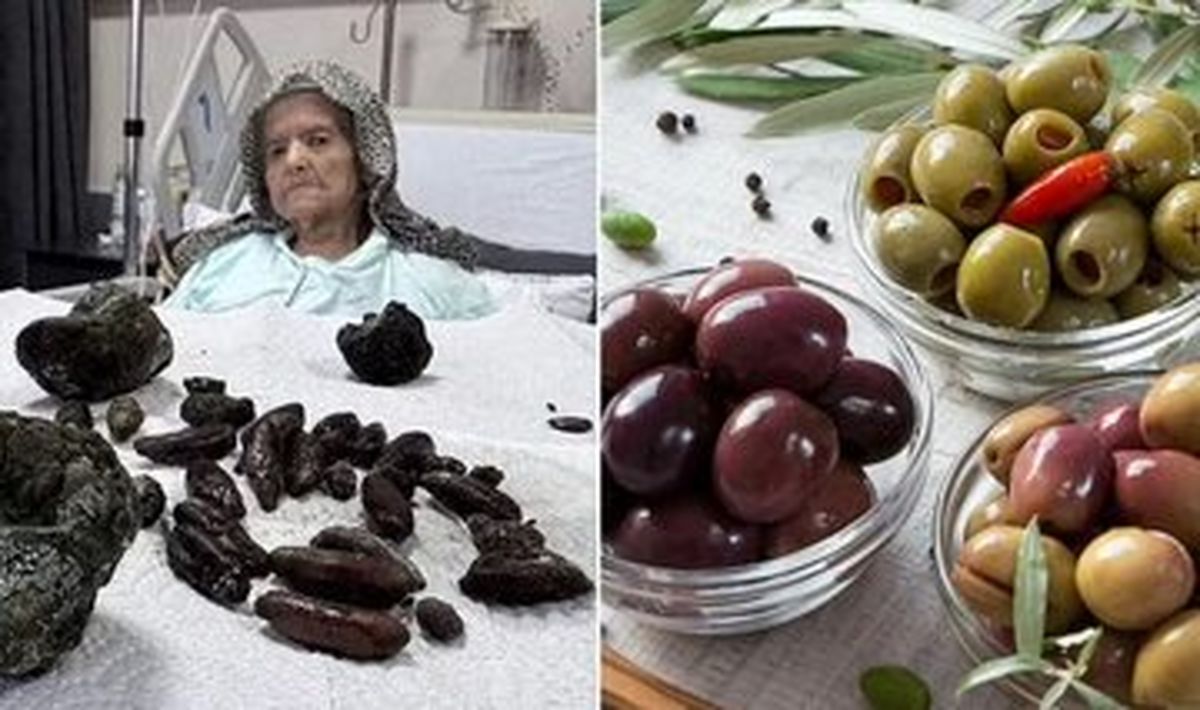 این زن ۹۲ ساله تا چند قدمی مرگ رفت/ بلعیدن ۳۵ هسته زیتون و ۲۸ هسته خرما/ عکس