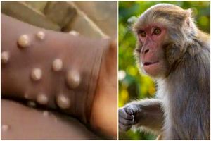 موذی گری تازه ویروس آبله میمونی