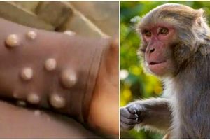 هشدار WHO نسبت به افزایش مرگ و میرهای آبله میمونی در جهان