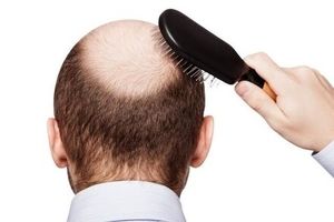 آیا مکمل «بیوتین» در جلوگیری از ریزش مو موثر است؟