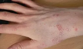 وزارت بهداشت شیوع غیرمعمول بیماری گال را تایید نکرد