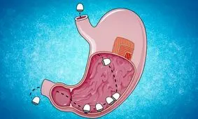 کپسولی که می‌تواند جایگزین واکسن شود!
