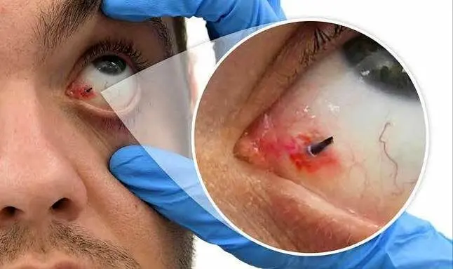 در زمان تروما یا ضربه به چشم در اثر انفجار چه باید کرد؟/ هشدار: به آسیب‌دیدگان چشمی، آب یا غذا ندهید/ خوددرمانی با قطره و مالش چشم، ممنوع!