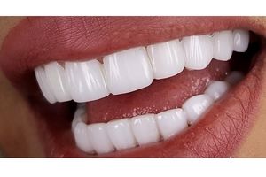 چرا دندان های خراب برای سلامتی مضر هستند