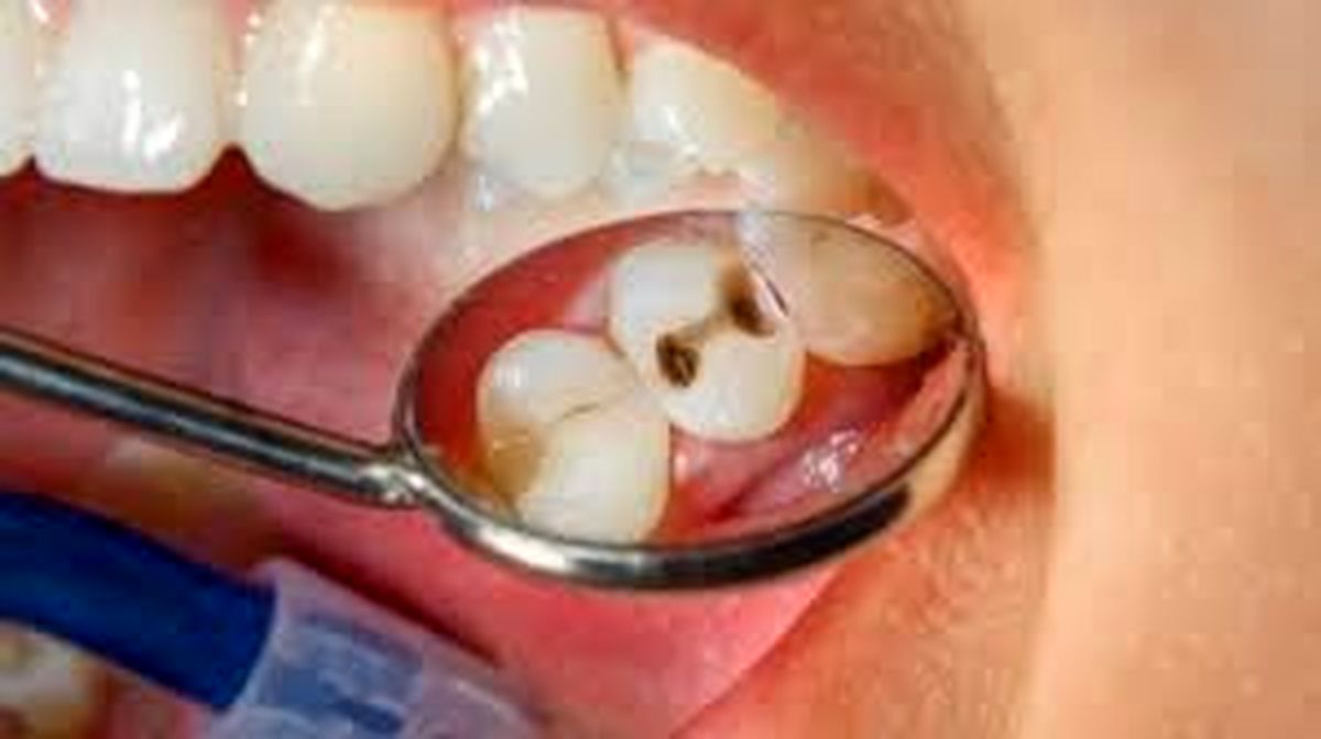 ۵ عادت نادرستی که دندان هایتان را خراب می‌کند