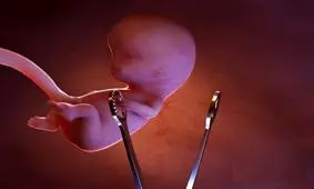 محدودیت جدید برای سقط قانونی/ بعد از رای قاضی، فقط به بیمارستان‌های مورد تایید پزشکی قانونی مراجعه شود